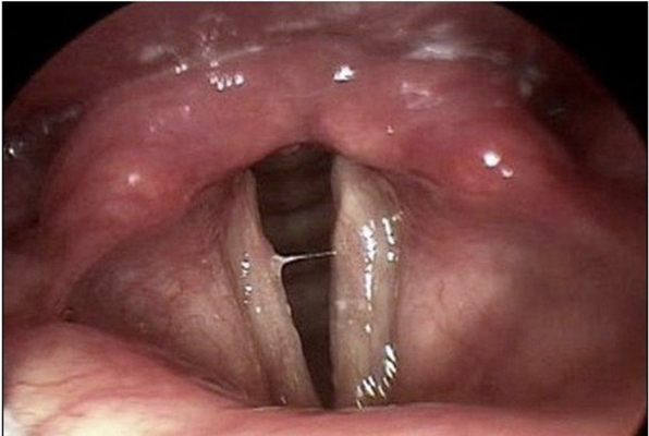 喉癌图片 (17)