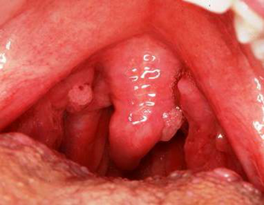 喉癌图片 (3)