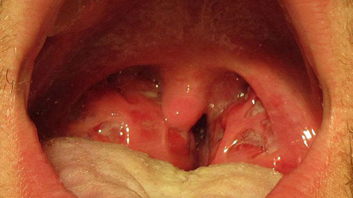 喉癌图片 (32)