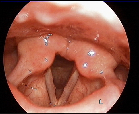 喉癌图片 (35)