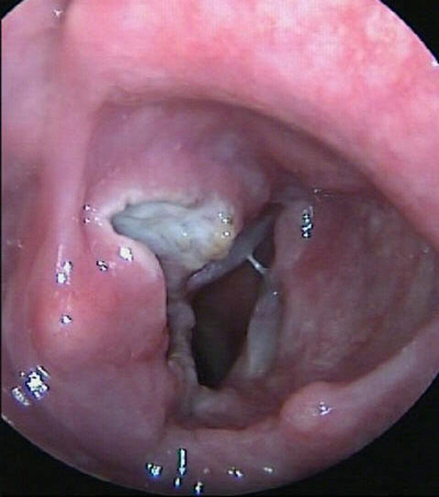 喉癌图片 (40)
