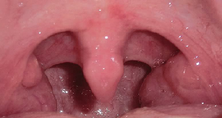 喉癌图片 (43)
