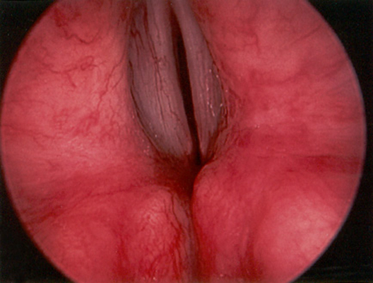 喉癌图片 (38)