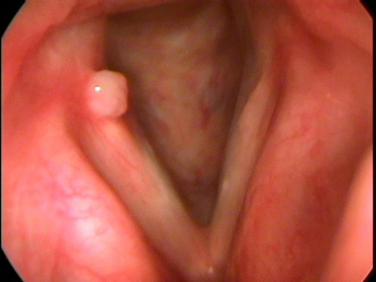 喉癌图片 (49)