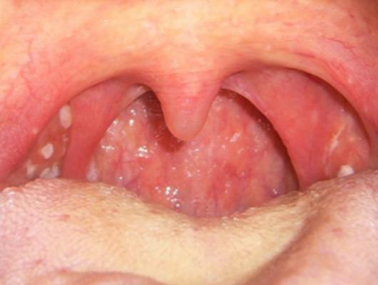 喉癌图片 (46)