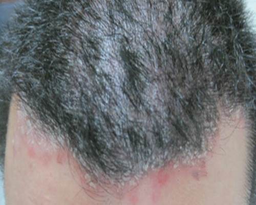 头皮癣早期症状图片5