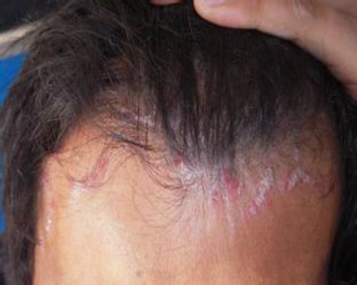 头皮癣症状图片 治疗图片