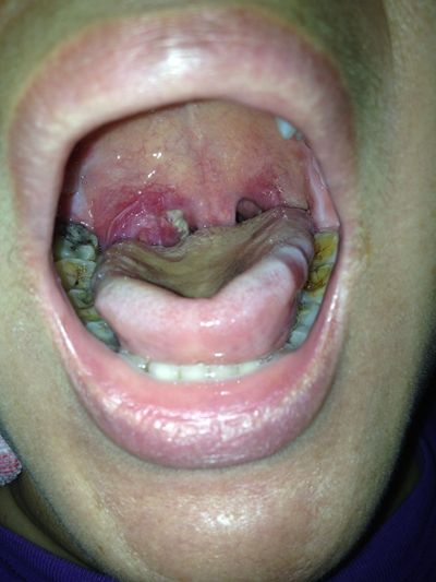 鼻咽癌早期的五大症状图片