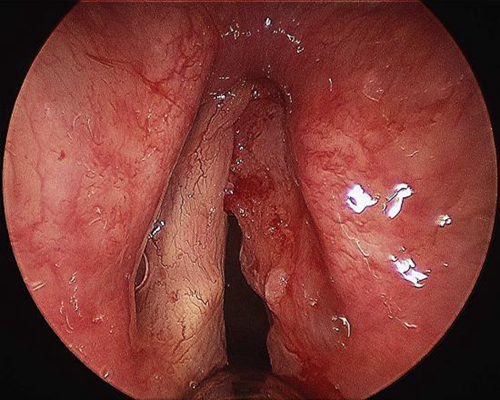 喉癌图片 (54)