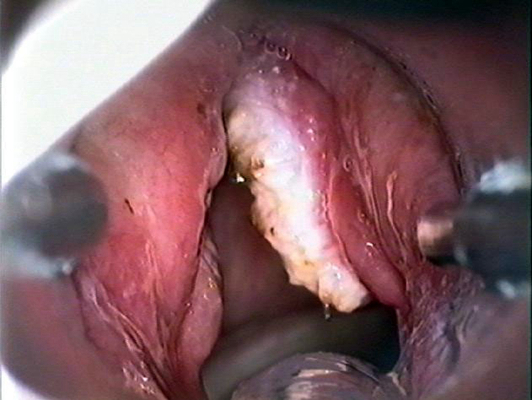 喉癌图片 (7)