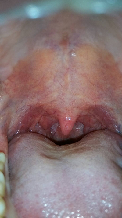 鼻咽癌图片肿物图片