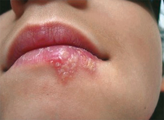 唇膜炎的症状图片