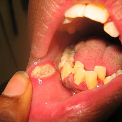 恶性口腔溃疡的特征图片