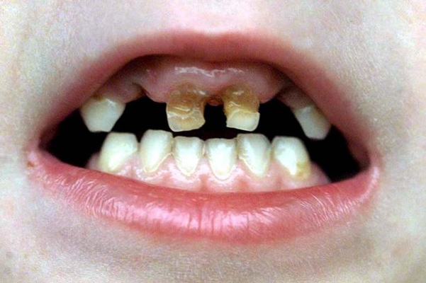 儿童牙齿发黑龋齿图片43