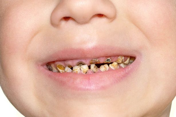 儿童牙齿发黑烂掉图片图片