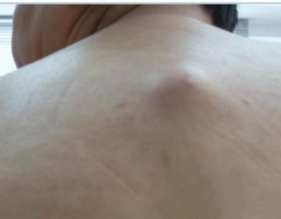 皮下脂肪瘤图片 (33)
