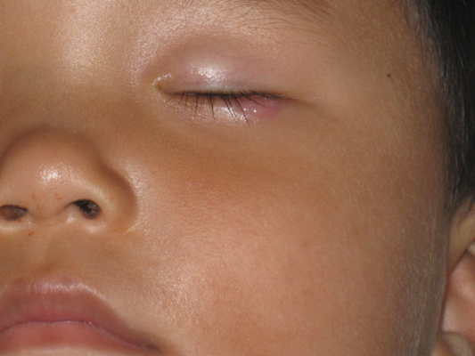 麦粒疹子初期症状图片图片