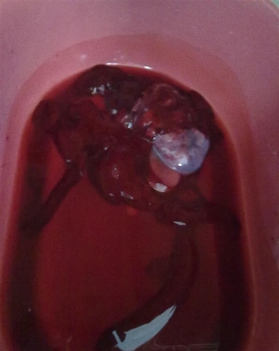 流产掉下来的孕囊图片 (16)