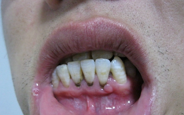 牙龈癌图片征兆图片