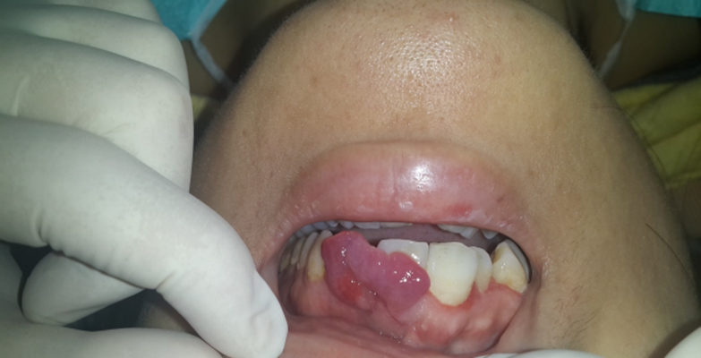 牙龈癌图片 晚期图片