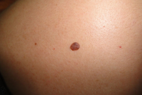 丘疹型软纤维瘤图片