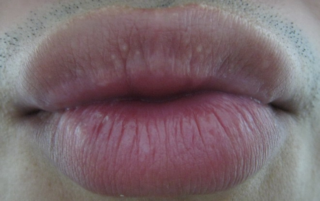 艾滋病的嘴唇图片