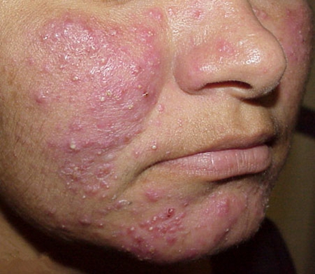 皮肤萎缩性皮炎的图片图片