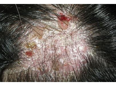 头皮癣症状图片 治疗图片
