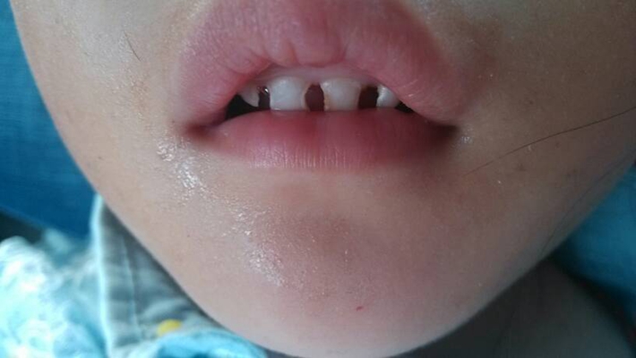 一岁宝宝牙齿钙化图片