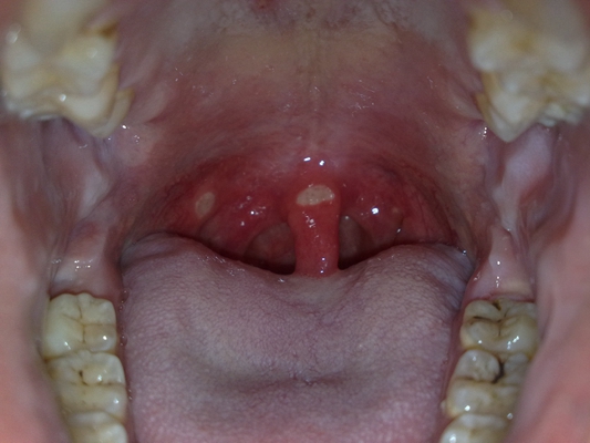 嘴巴里面溃疡图片49