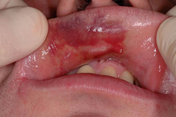 口腔恶性溃疡图片