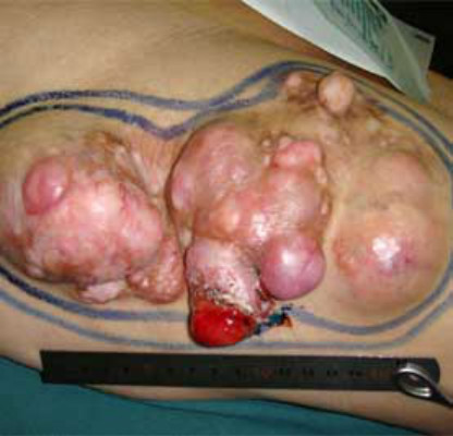 骶尾部脂肪瘤图片图片