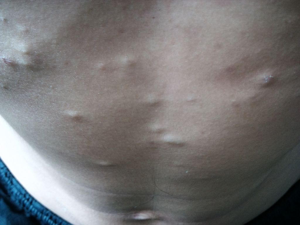 皮下脂肪瘤图片 (29)