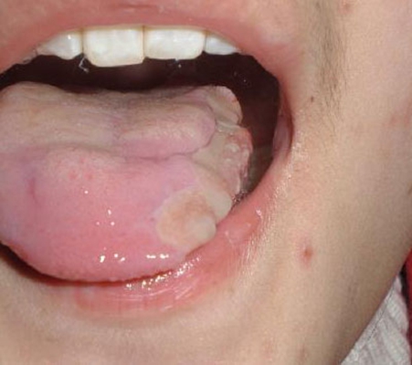 口腔白斑早期图初期图片