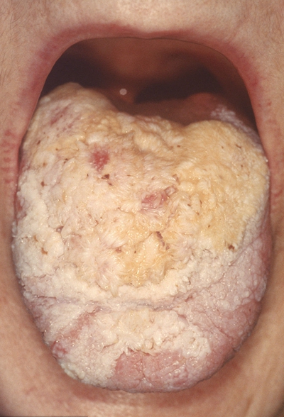 口腔毛状粘膜白斑图片图片