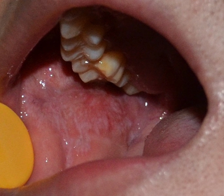 口腔黏膜白斑病图片