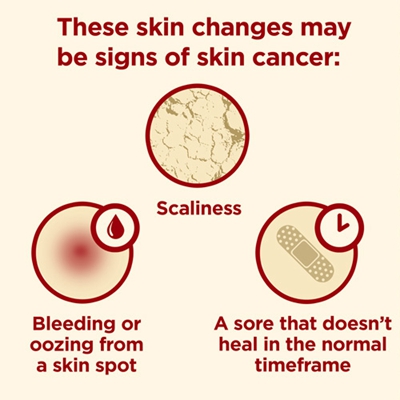 皮肤癌早期症状 (1)