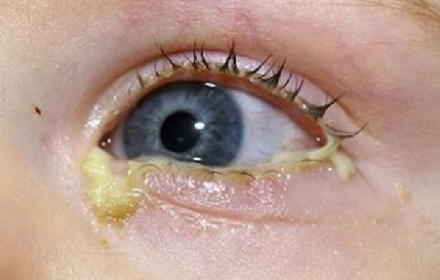 眼睛泪囊炎的症状图片图片
