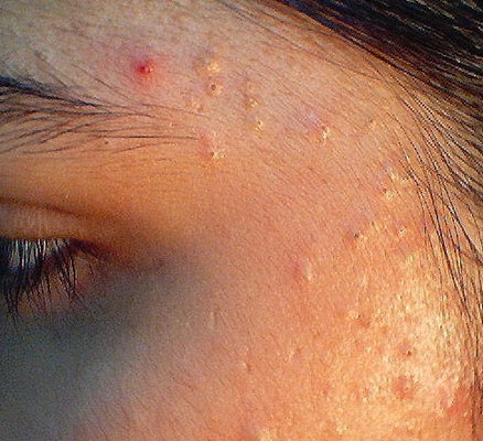 粉刺瘤初期图片