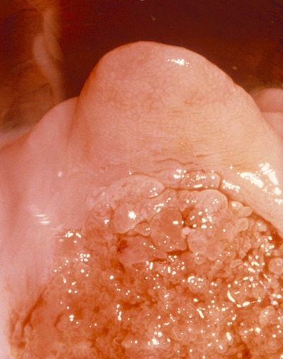 宫颈赘生物图片真实图片
