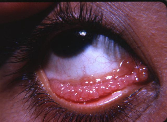 眼结石初期症状图片图片