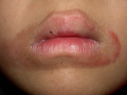 嘴唇疱疹感染图片 (10)