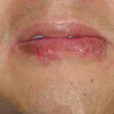 嘴唇上的皮肤病有哪些图片