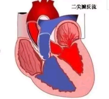 心脏瓣膜反流症状