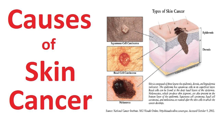 皮肤癌早期症状 (2)