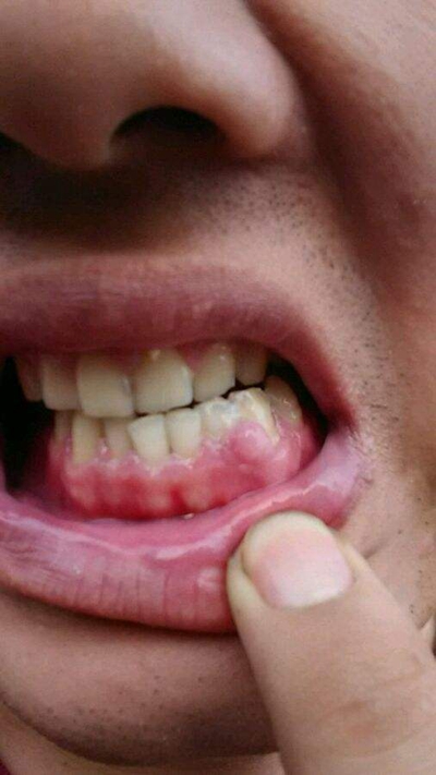 牙龈纤维性增生图片图片