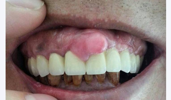 牙龈疤痕图片