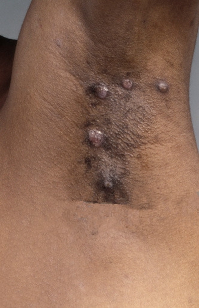 腋窝皮脂腺瘤图片