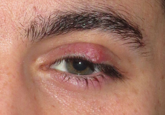 眼皮发炎的症状图片图片
