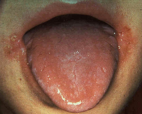 嘴角念珠菌感染图片图片